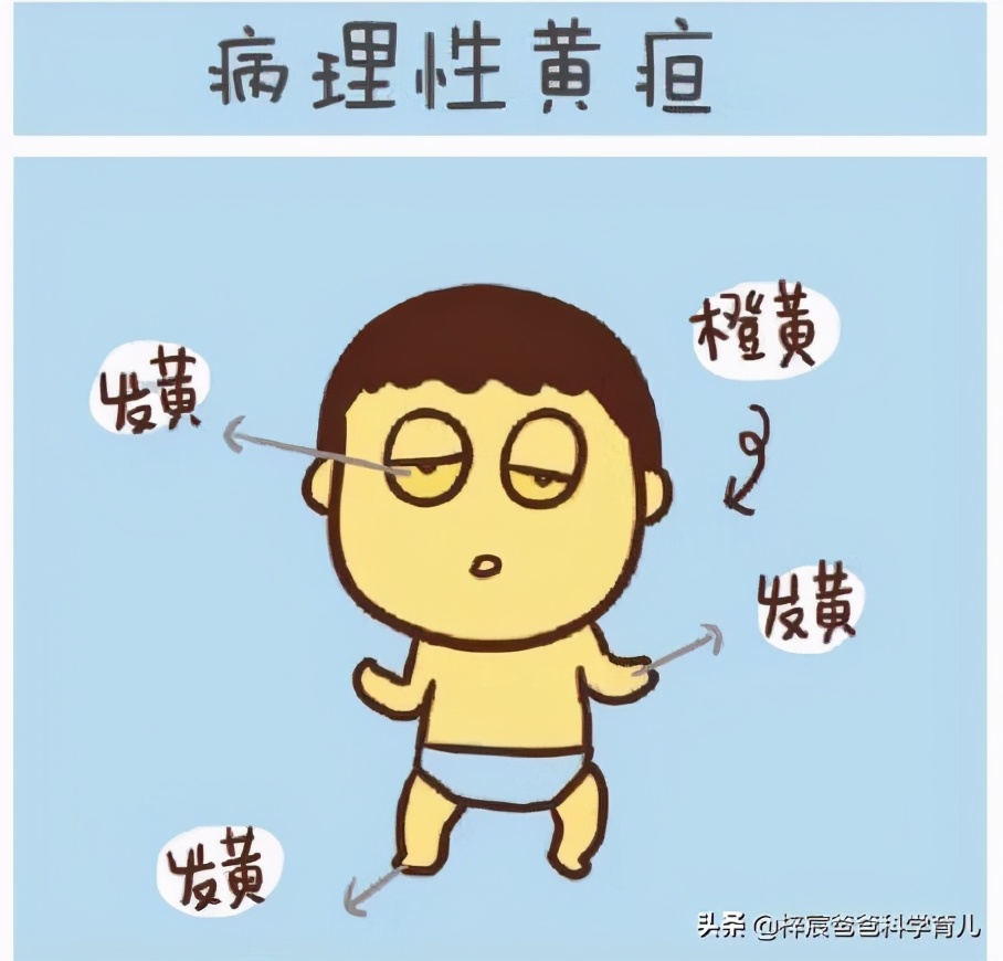 几乎90%的新生儿都有黄疸,正确分辨黄疸的类型可以省不少钱