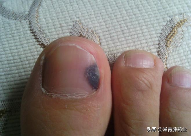 指甲变黑了是身体出了问题吗,黑指甲是否有癌变的可能?