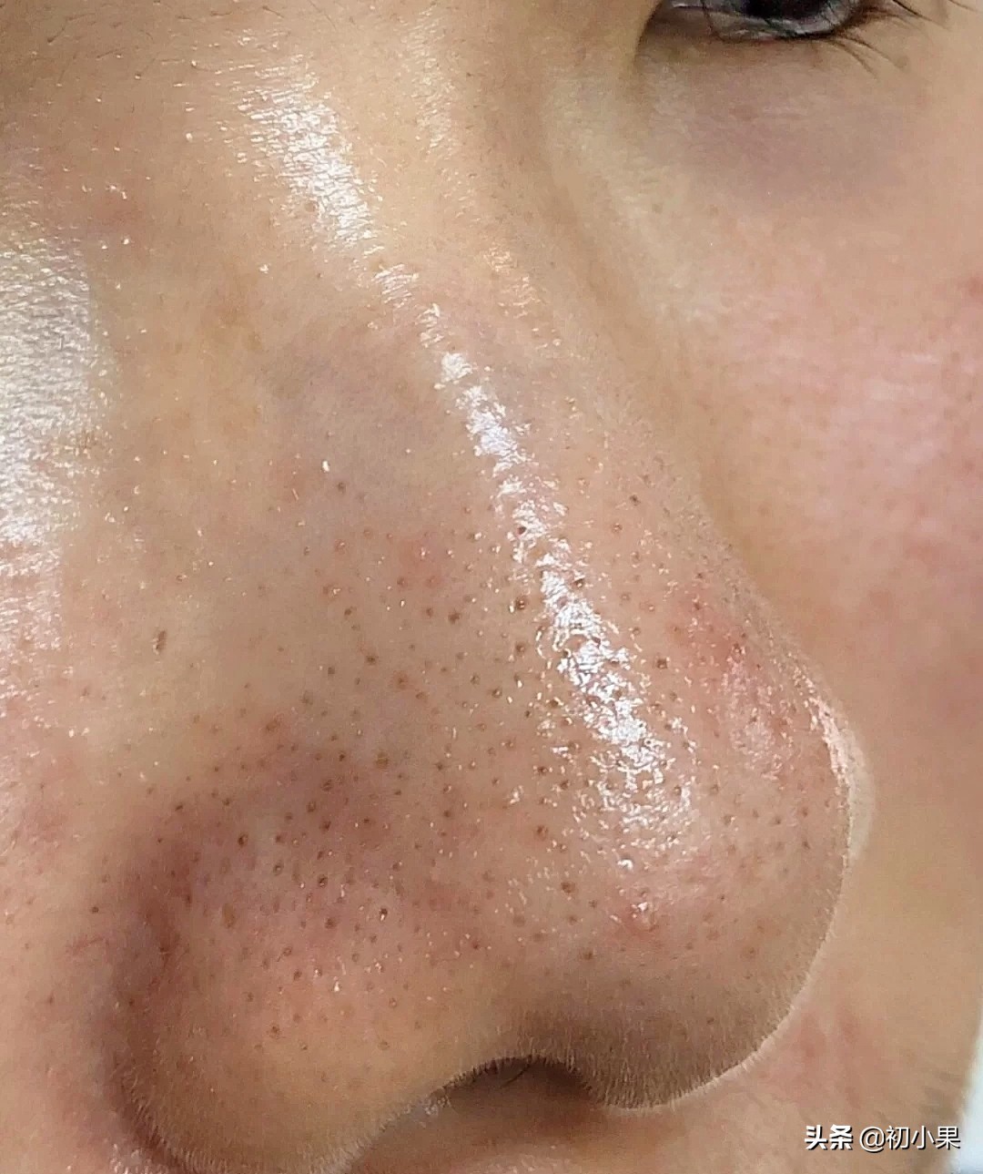 鼻子上的黑头怎么去除