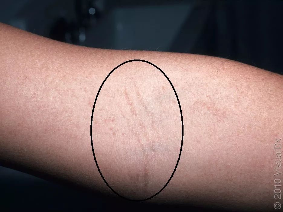 褪色,这种密集的皮疹经常呈线状排列,称为帕氏线(是个姓帕的人命名的)