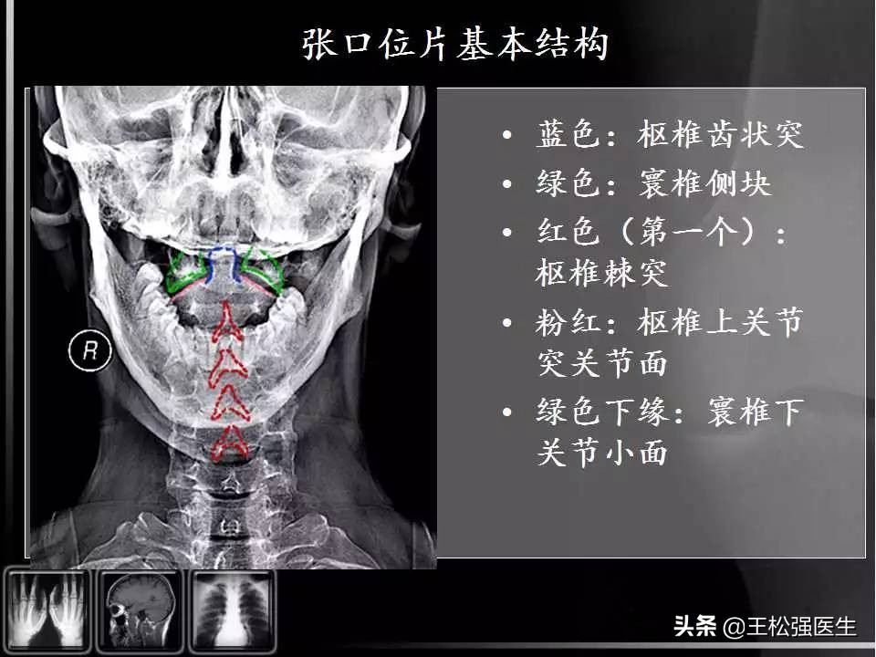 颈椎X光片