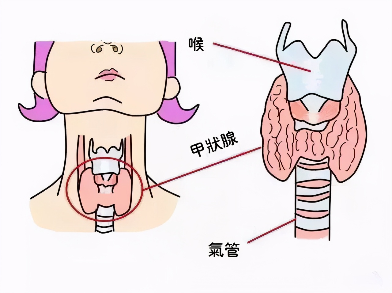 甲状腺癌早期的五大症状，越早发现越好