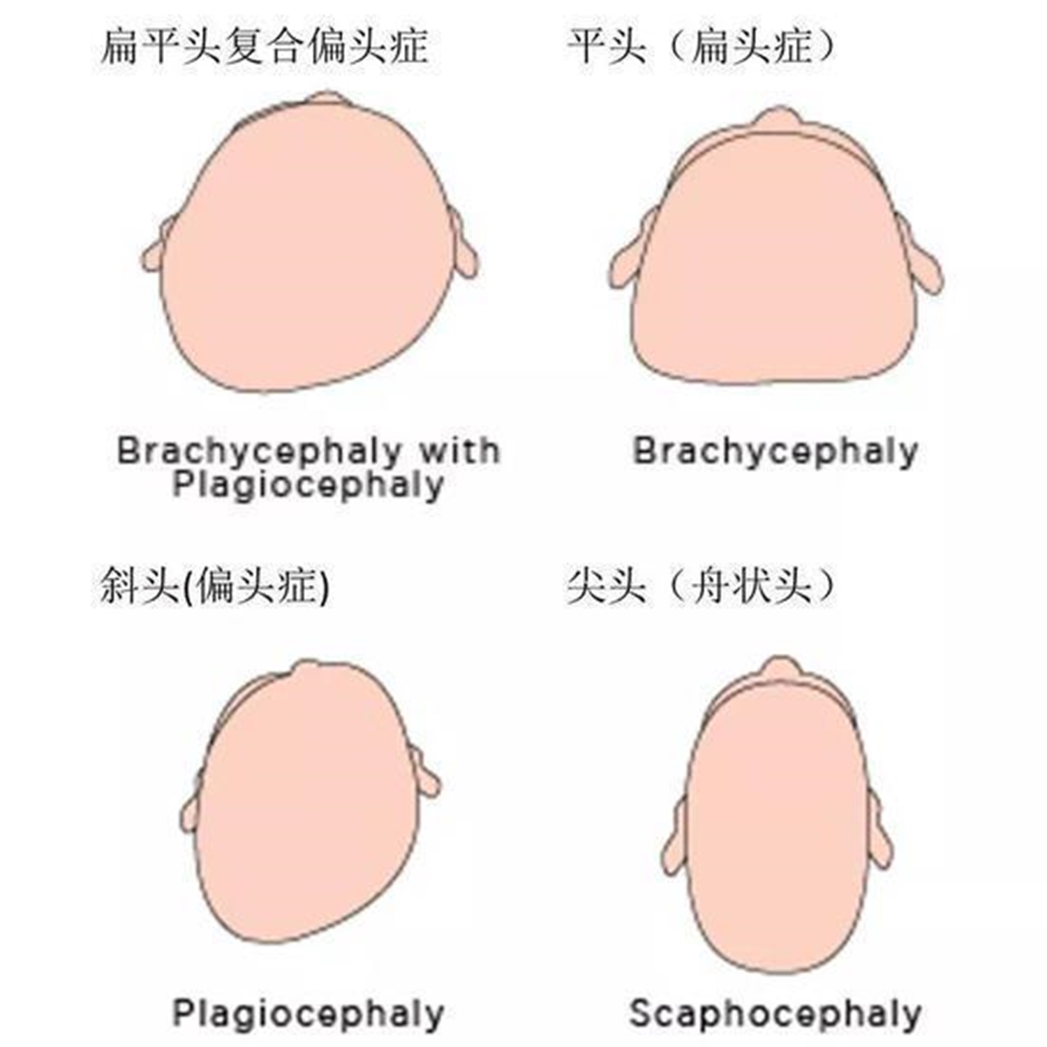 95后小伙被发型愁坏了，扁头太影响颜值，宝宝4个月内还能纠正