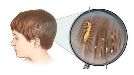 去除虱子卵最好小窍门（去虱子和虱子卵的有效方法）