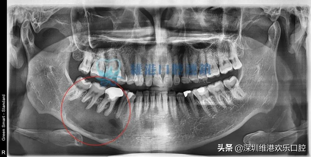 根尖囊肿免费公益筛查，防止牙槽骨破坏和脸部畸形