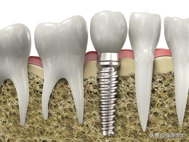 种植牙、烤瓷牙和镶牙哪个好？一起来说说牙齿那些事