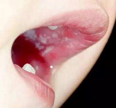 舌头疱疹图片(疱疹性咽峡炎又到高发期) - 赤虎壹号