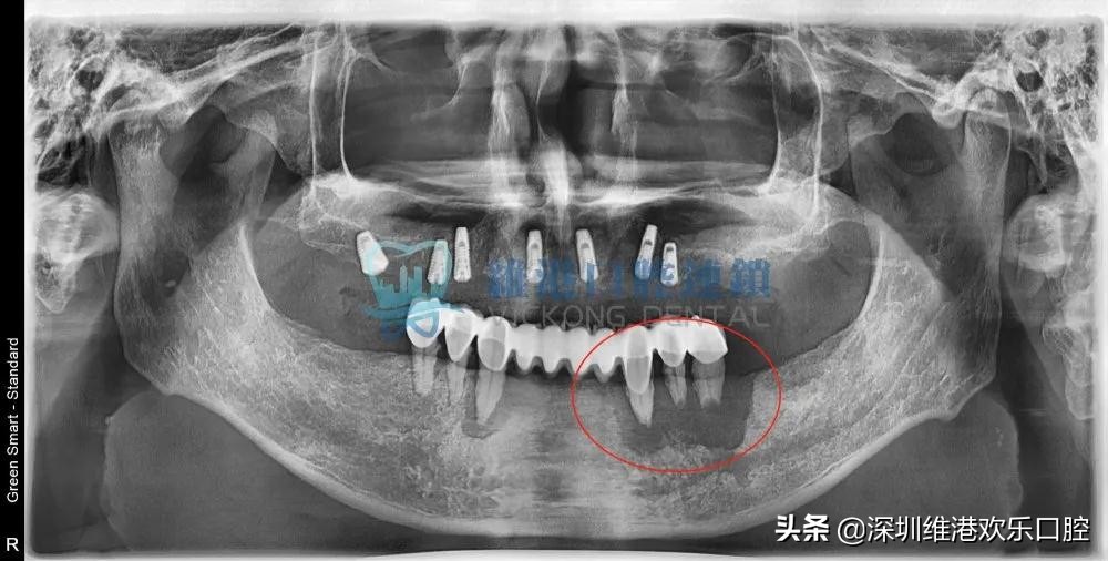 根尖囊肿免费公益筛查，防止牙槽骨破坏和脸部畸形