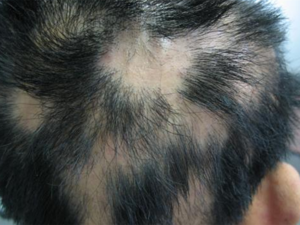 秃头症有的宝宝不是缺钙,却也不是正常枕秃,而是大部分头发都会掉落