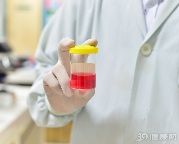 尿检发现隐血是怎么回事？体检报告提示尿潜血需警惕