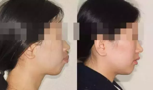 龅牙嘴突+露龈笑：牙齿矫正告诉你这些都还有救