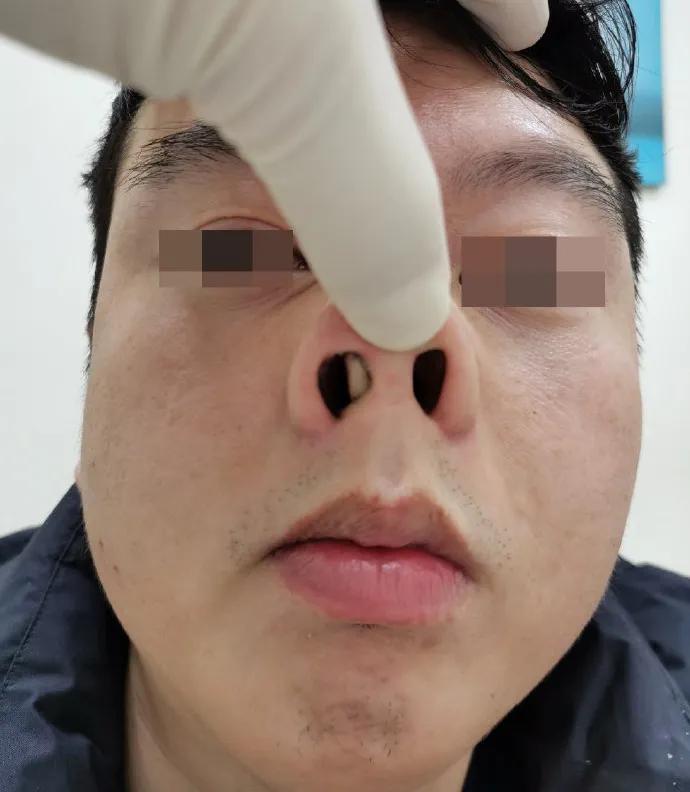 严重鼻中隔偏曲患者需手术治疗