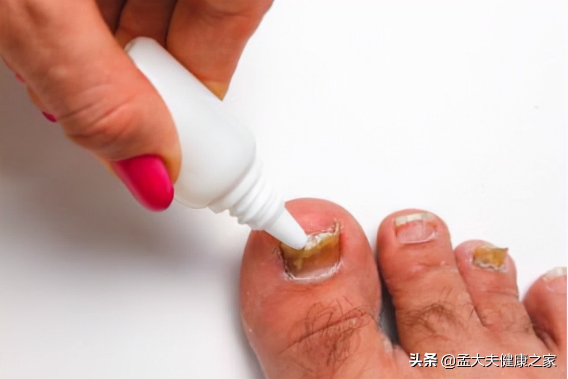 得了灰指甲怎么治？2个治疗方法效果好，安全不复发