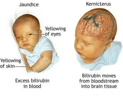 新生儿黄疸是怎么回事？肝病专家对高胆红素血症的答疑解惑
