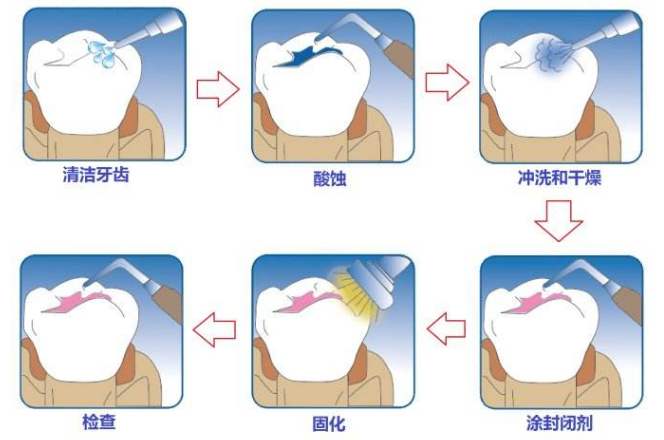 儿童预防龋齿能做窝沟封闭吗？几岁可以做？家长想知道的都在这里