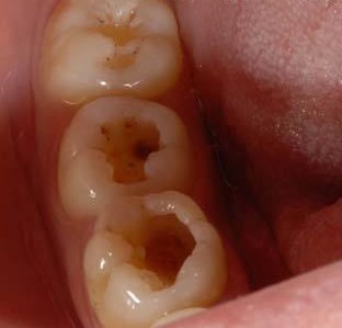 90%的孩子都有蛀牙：别再让孩子补牙，这个方法更有效