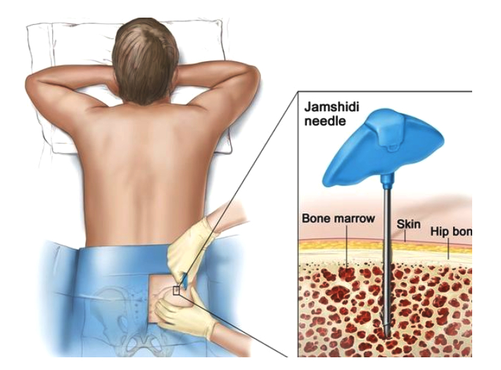 很多人对此项检查感到恐慌或畏惧,对抽骨髓闻之色变,觉得会伤害身体