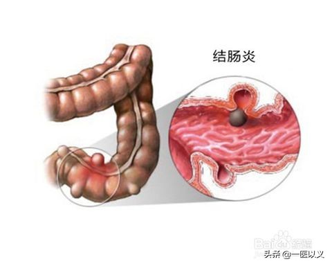 胀气拉肚子怎么办(经常拉肚子、腹胀、腹泻怎么办？医生：3种疾病要早发现早治疗)