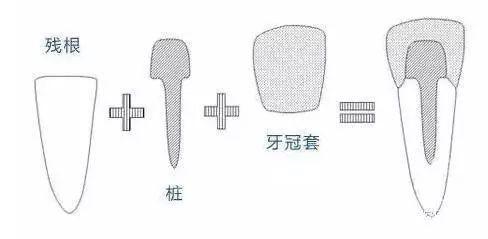 为什么做牙齿修复的时候，要给牙齿打桩？牙医告诉你到底有什么用