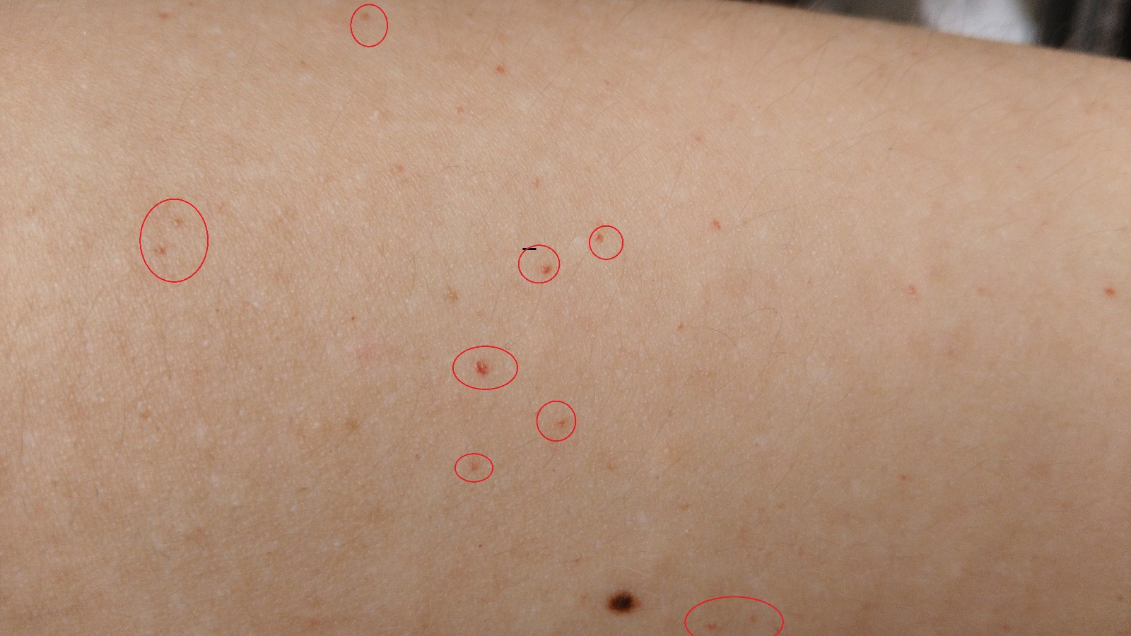皮肤上的小红点别忽视,可能是癌症预兆!不疼不痒,仍要防4种病