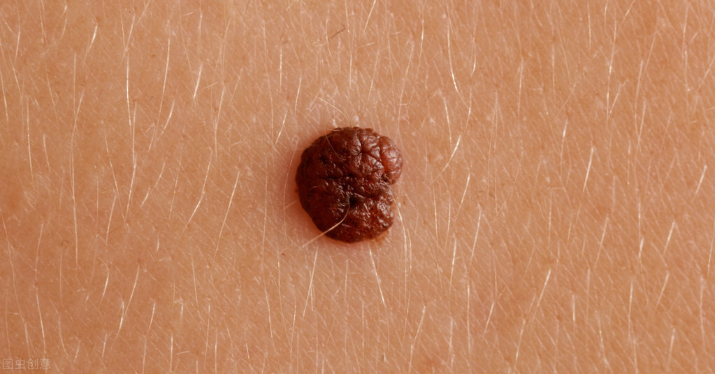 身上的黑痣越长越大是怎么回事?