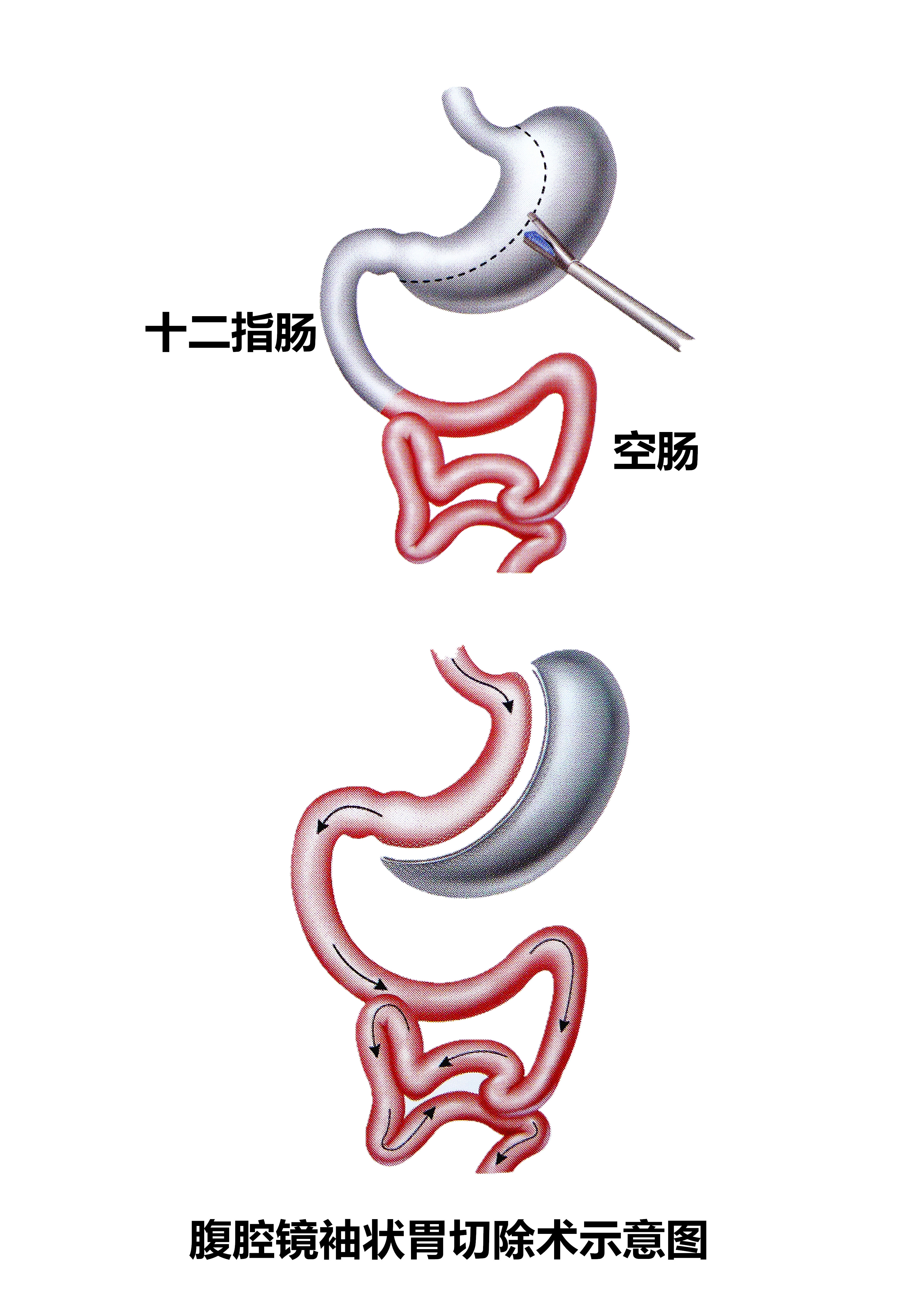 胃溃疡需要切除胃吗「胃镜糜烂性胃炎严重吗」