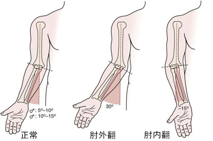骨科医生:如果孩子手臂不太直,符合以下情况的需要治疗