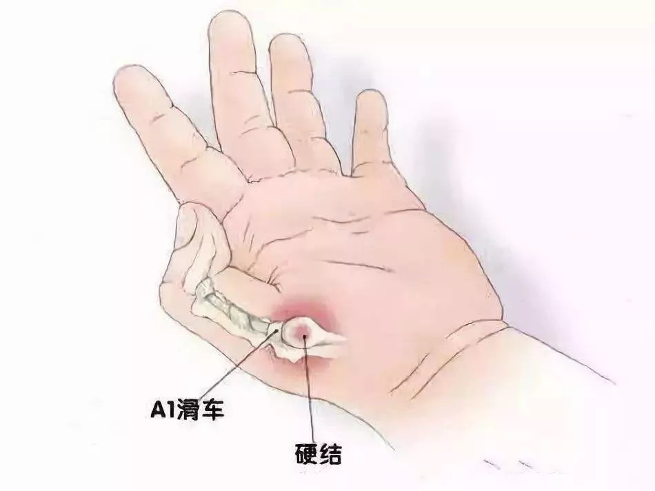 手指充血,水肿使不上劲,按摩就能好?腱鞘炎有效治疗看这里!
