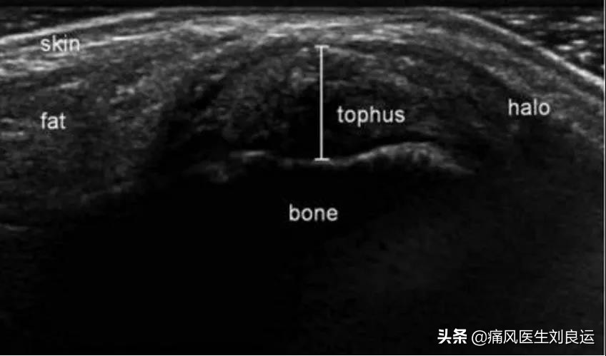 痛风患者都会长出痛风石吗？医生介绍痛风石治疗的四种方法