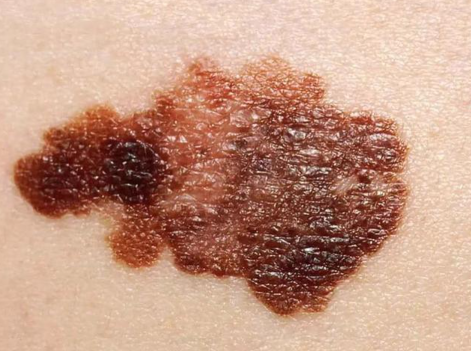 边缘不规则:发生恶变的色素痣边缘往往呈现切迹或锯齿等形状颜色改变