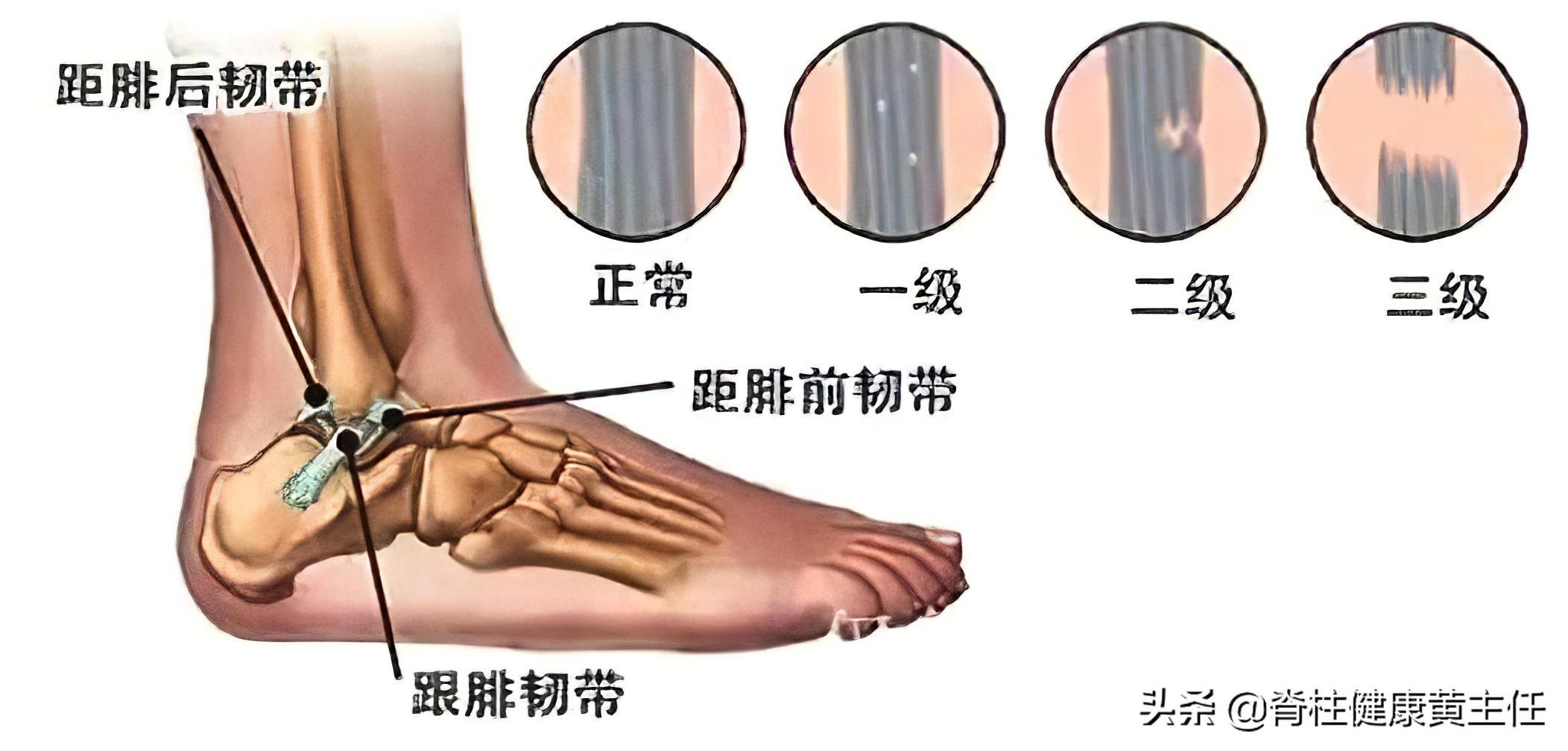 踝关节扭伤的正确处理方式
