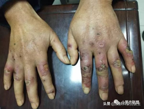 冰疮最初的症状图片(肿胀感) - 赤虎壹号