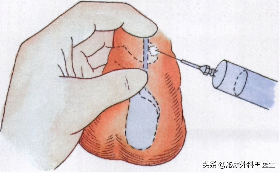 男性做了结扎，和正常人有区别吗？会不会影响性功能？