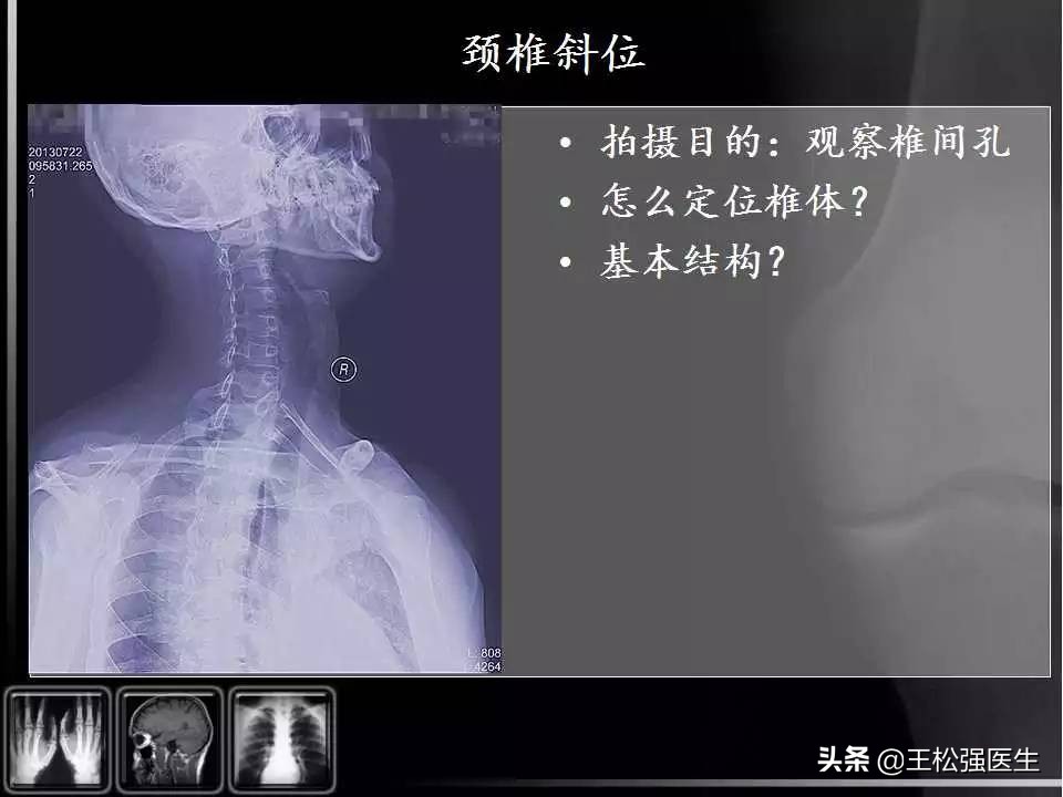 颈椎X光片