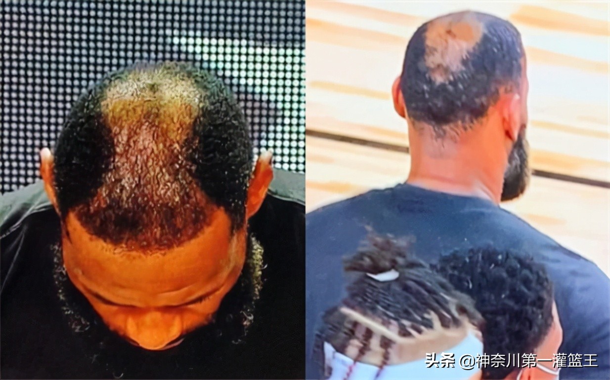 为什么nba的人不植发（詹姆斯植发才花费百万，吉诺比利谢顶时为何不植发挽救形象？）-趣拿体育