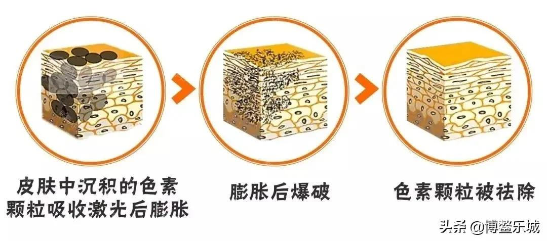 国内首台PiQo4激光治疗仪来啦!祛斑“黑科技”了解一下
