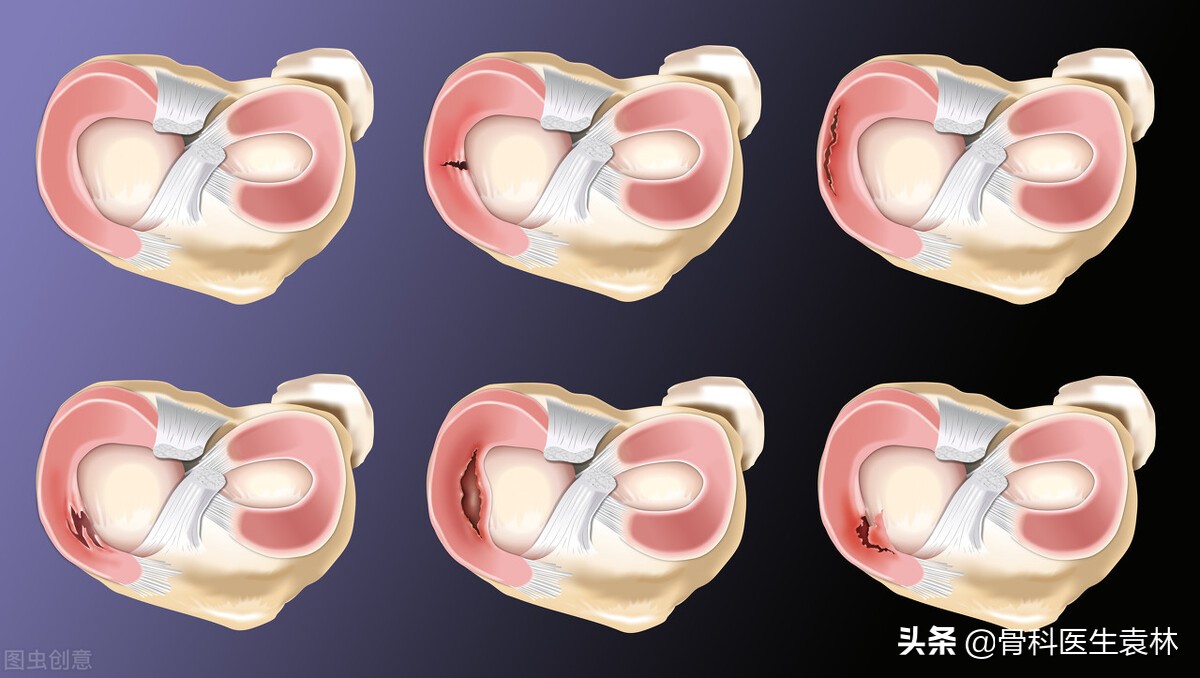 膝关节弹响是怎么回事？膝关节弹响该怎么办？