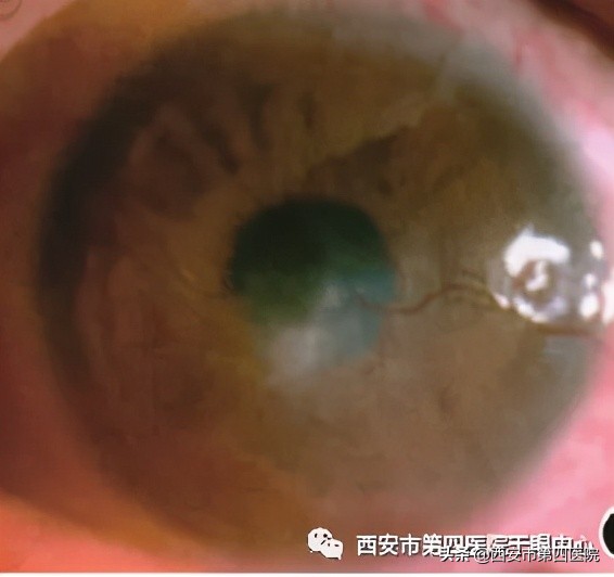 #健康中国行动2030# 总是眼痒、眼干、流泪？三种治疗方式来了解！