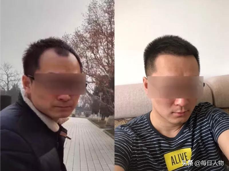中国脱发人群数量达2亿，植发真的能拯救中国人的发际线吗？