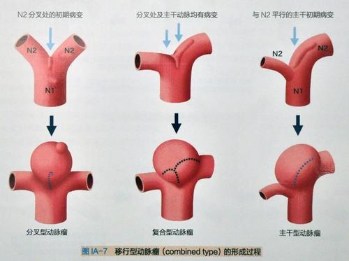 腦動脈瘤手術放支架可靠嗎?三甲醫院腦血管醫生一席話讓你放寬心