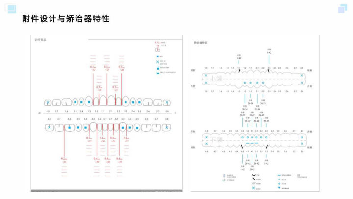 广州牙齿矫正杨露隐适美隐形矫正戴牙套全案例