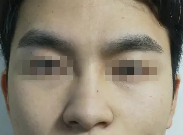 男女隆鼻的相同与差异,体现在哪些方面