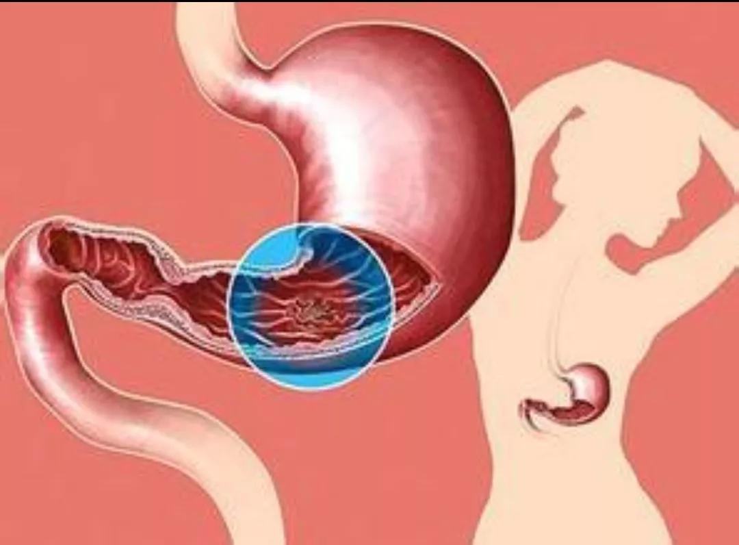 胃黏膜损伤不吃药能自己修复嘛？胃病三分治七分养，该如何养胃？