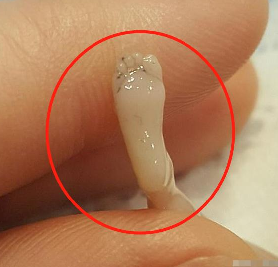 胚胎是什么样子的图片(女子怀孕14周流产) - 赤虎壹号