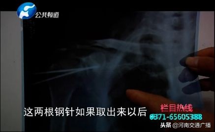 荒唐！开封一病人右肩骨折，医院竟给左肩拍片！更奇葩的是……