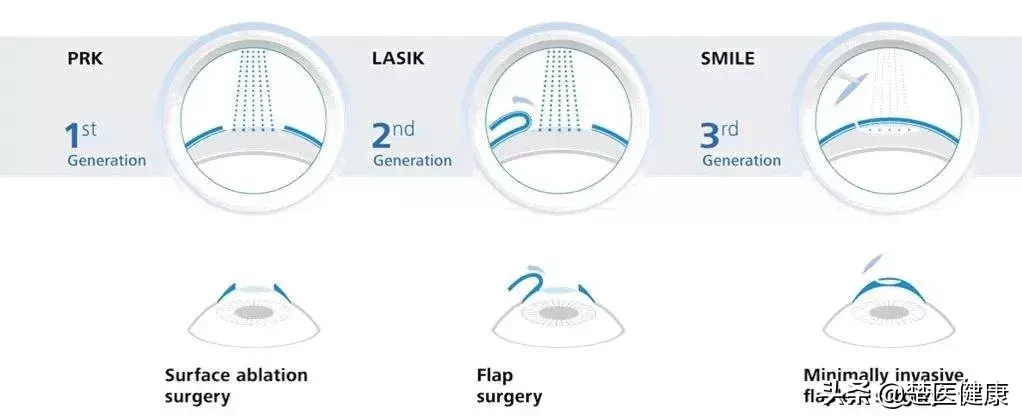 公立医院眼科医生揭秘：近视激光手术到底靠不靠谱