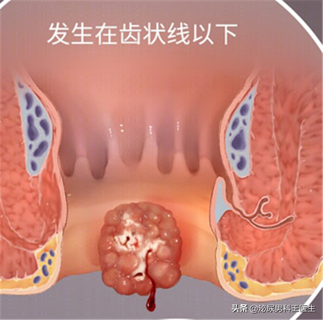 “难以启齿”的肛门癌，你了解它吗？出现6个症状，及时就医检查