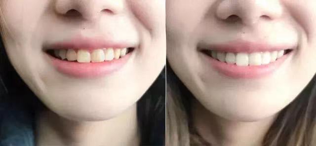 笑起来好看的女星都有一口假牙！牙齿要重视，多数人都用错了牙膏