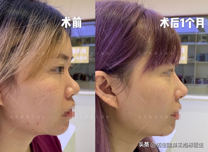 如何定义短鼻，短鼻延长后的改变有多大？