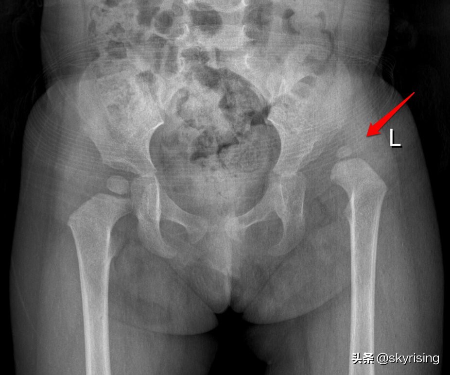 婴儿左侧髋关节先天发育不良并脱位DR典型影像表现